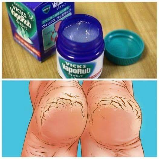 Se frotaba los pies con Vicks Vaporub todas las noches. El resultado te impresionará.